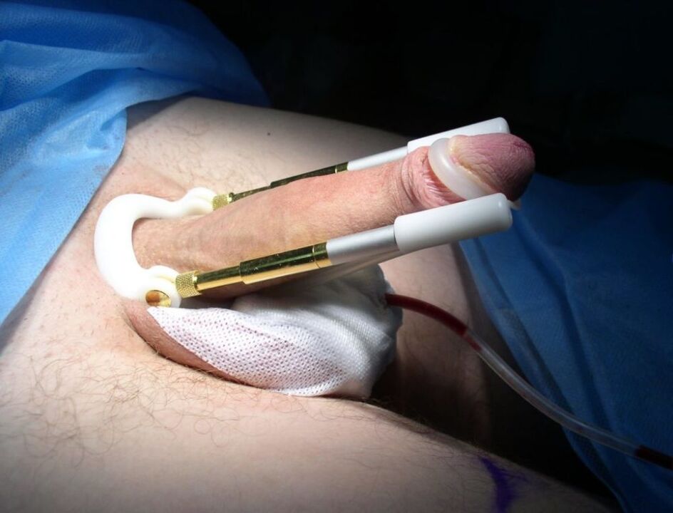 nošení nástavce po operaci