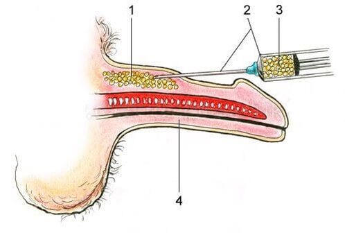 indikace pro operaci zvětšení penisu