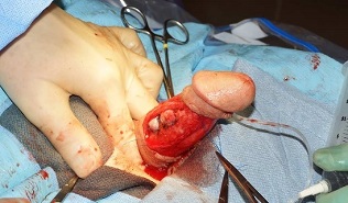 chirurgie zvětšení penisu