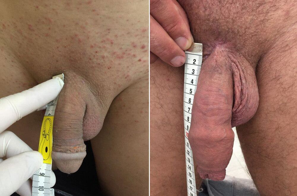 před a po operativním zvětšení penisu