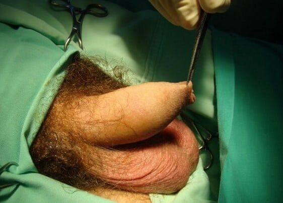 operace zvětšení penisu
