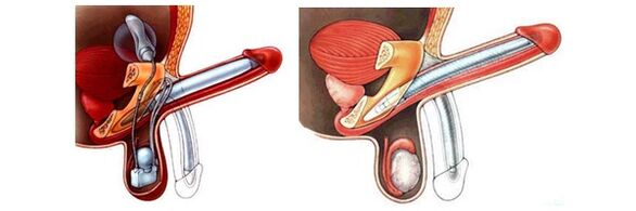 Faloprotetika s nafukovací protézou (vlevo) a plastem (vpravo)